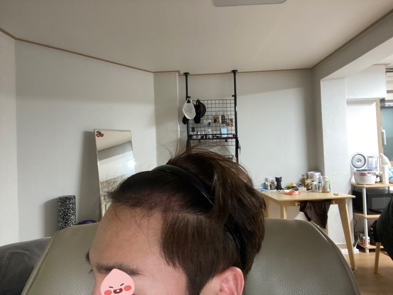 다나 (절개) 2900모 4개월차 후기