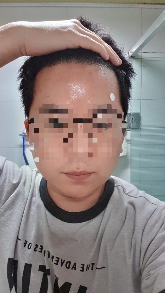 모재성 1년 경과 사진