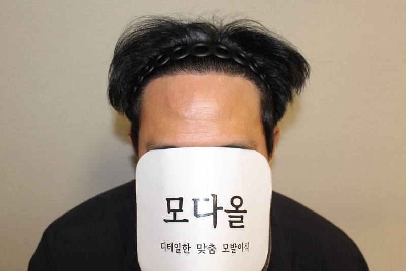 6개월경과 정면.jpg