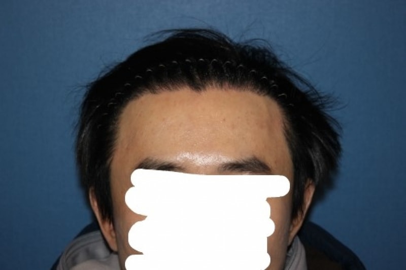 수술후 사진.jpg