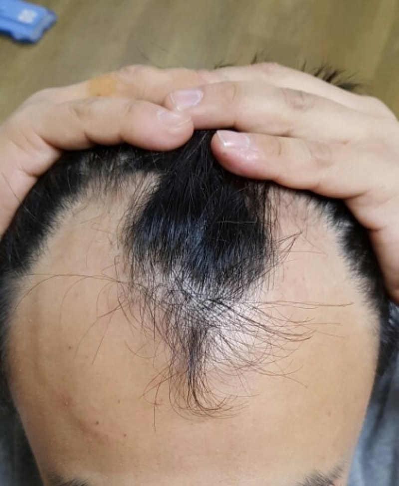 수술 6개월까지 경과