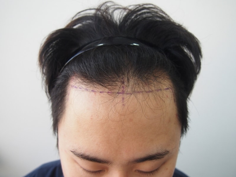 크기변환_수술전 정면.JPG