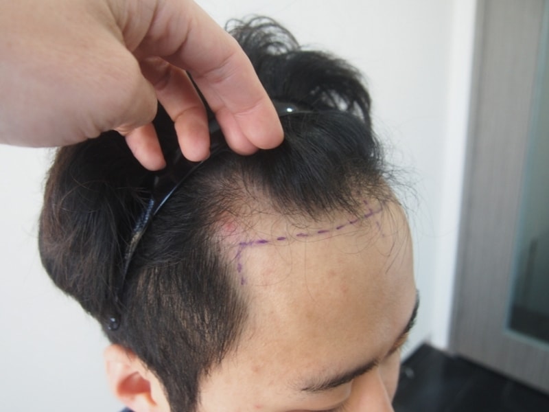 크기변환_수술전 우.JPG