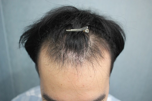 이식전1.jpg