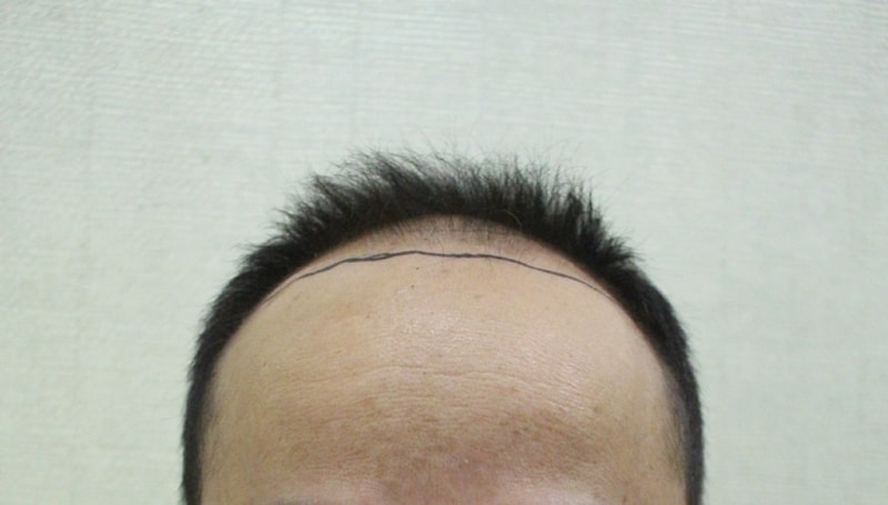 이식전01.png