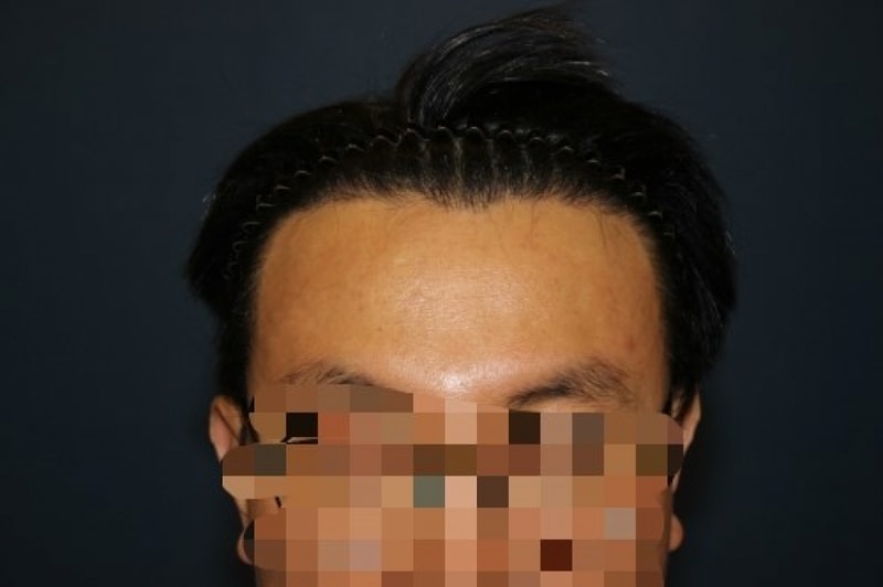 수술후2.jpg