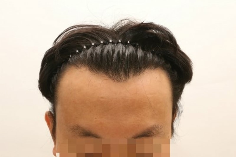 수술전2.jpg