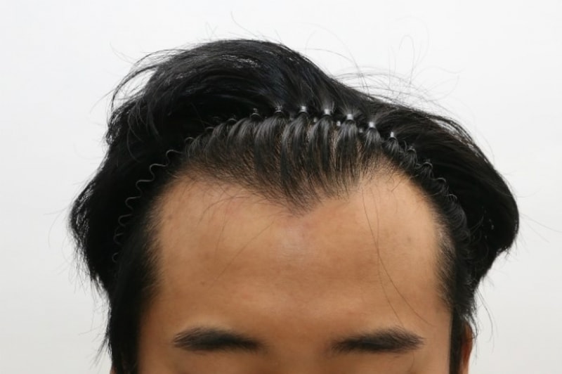 수술전.jpg