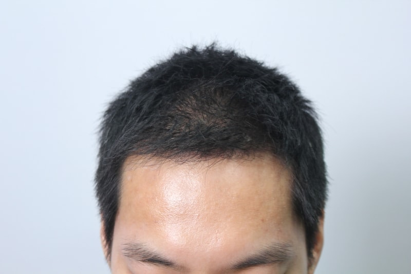 수술후 3개월 (3).JPG
