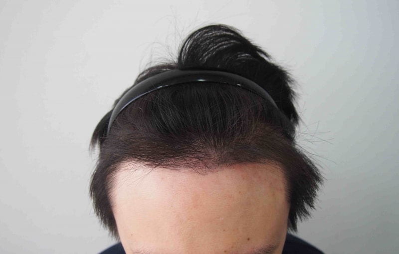 fix 4개월 정면.jpg