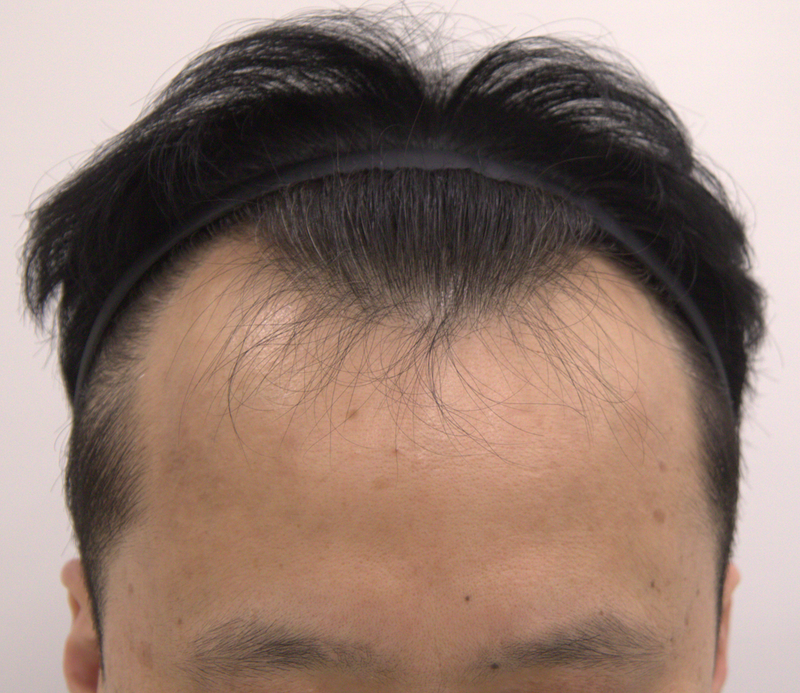 압구정 모발이식 비절개슬릿 5개월 후기입니다 (맘모스 헤어라인)
