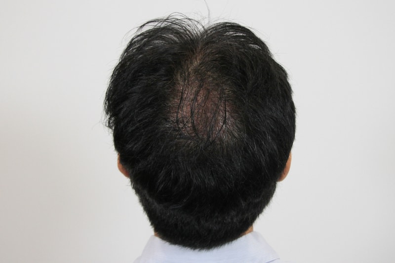 1d이식샴푸후-2.jpg