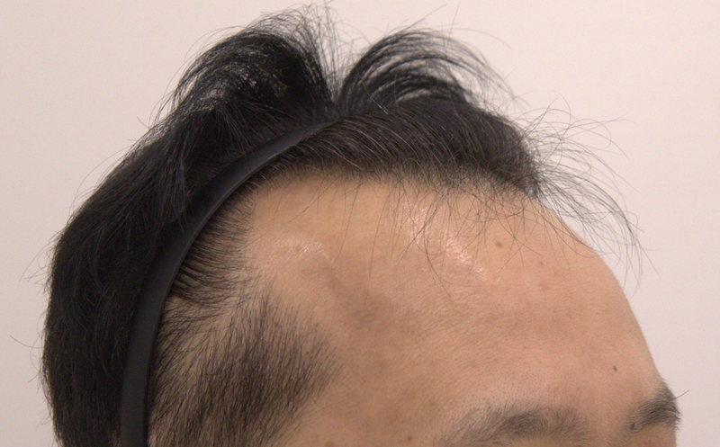 수술전측면.png