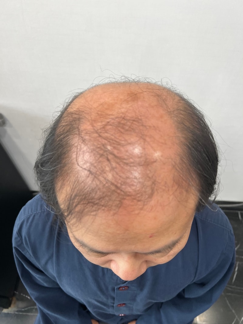 (모재성 모발이식센터) 모발이식 후기입니다.