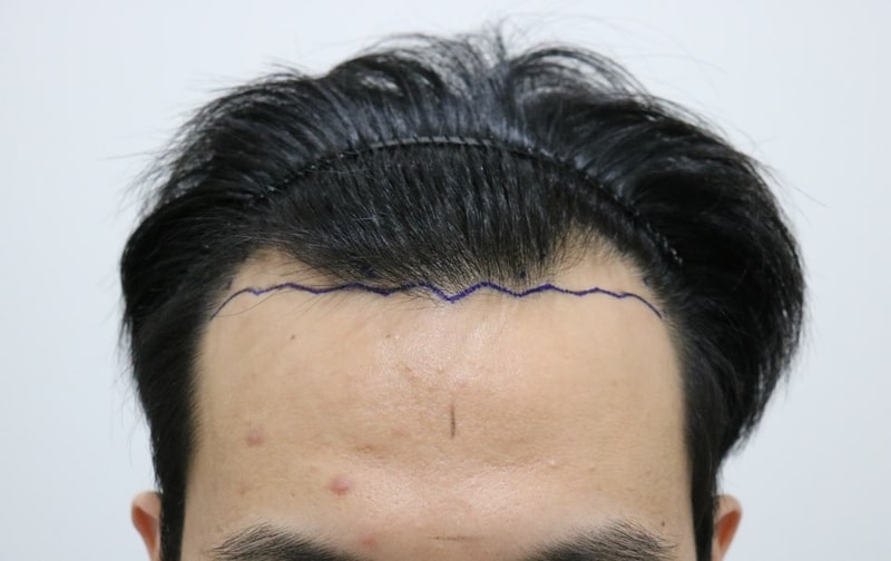 수술 전 디자인.jpg