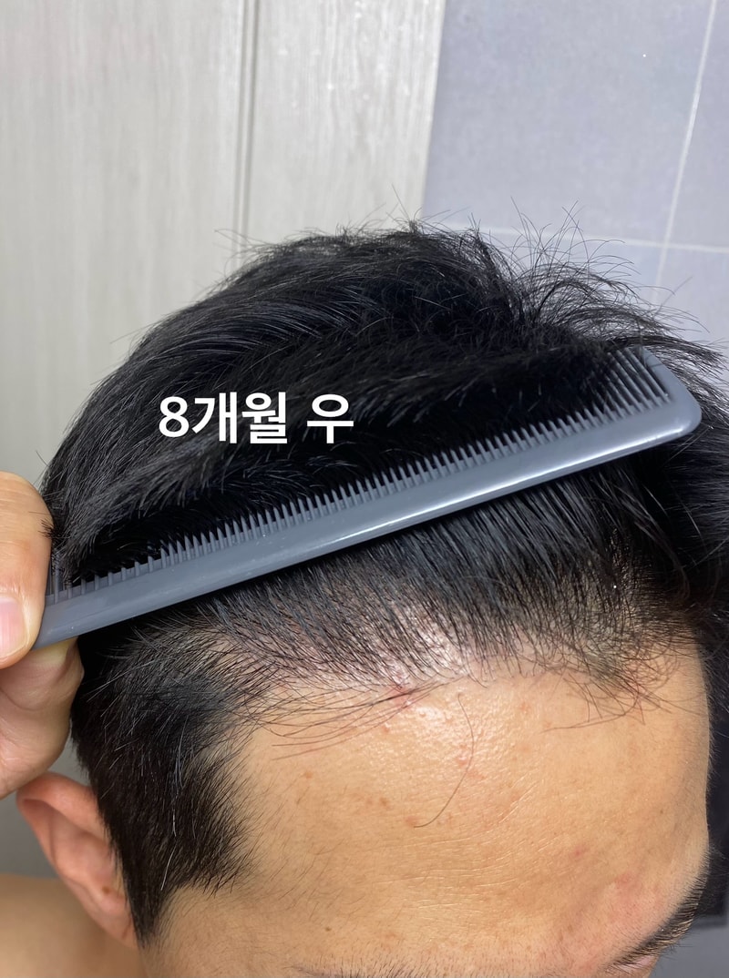 [8 months review] 1,421 hair follicles / 2,711 hair