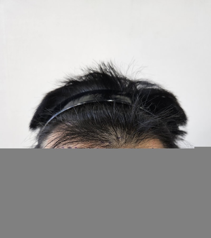A Review of Parental Hair Transplantation