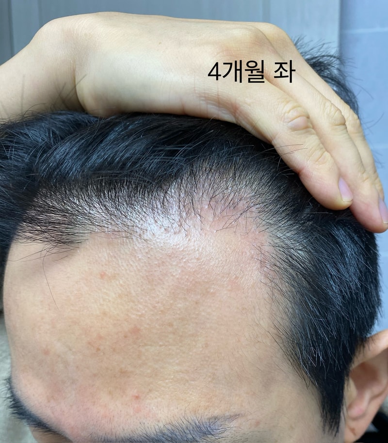 [4 months] B-cut