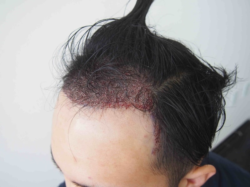 수술후 3.JPG