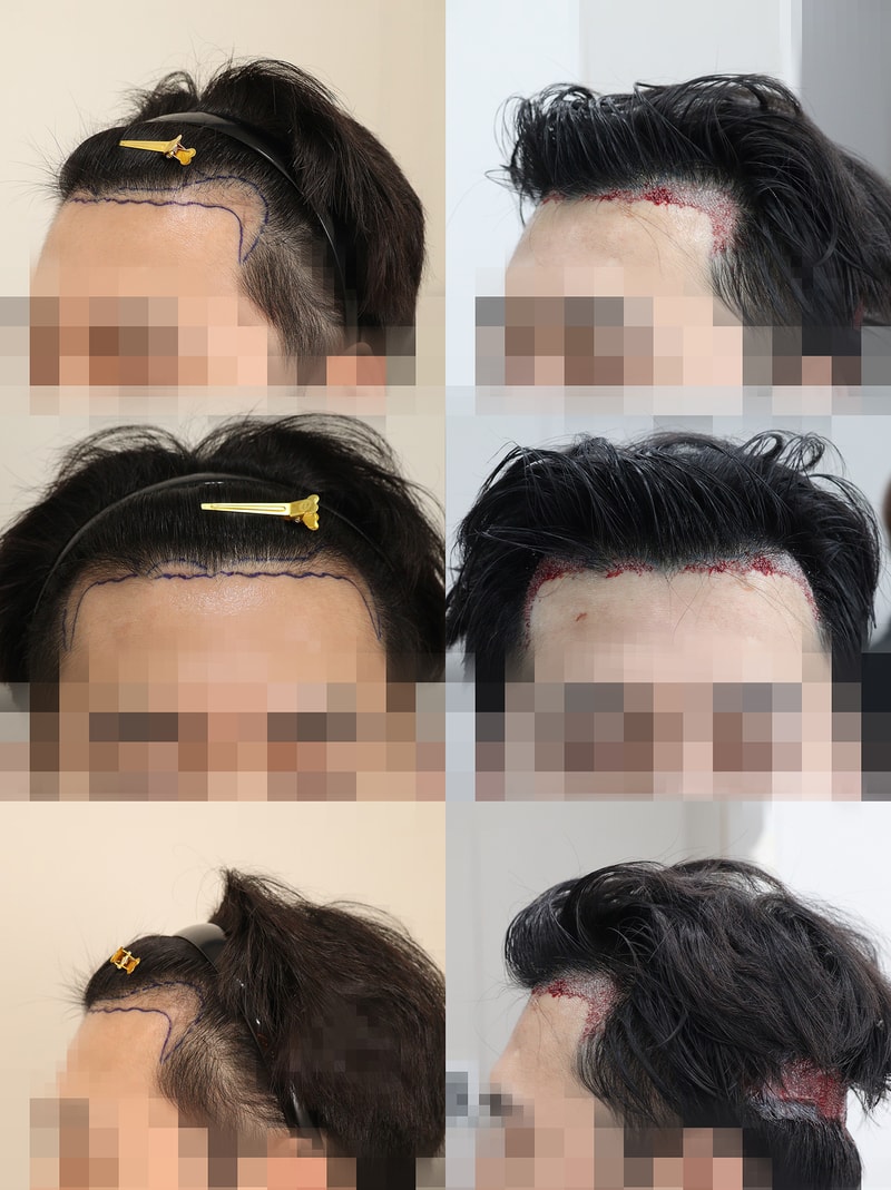 비절개 2000모 딱 2주 됐습니다. (후두부 포함)