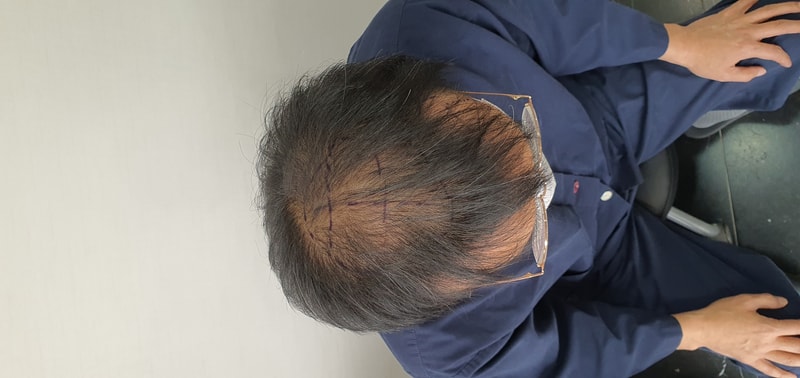 모발이식 1년차 후기