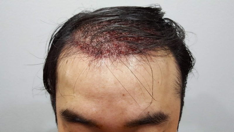 모발이식후 정면.jpg