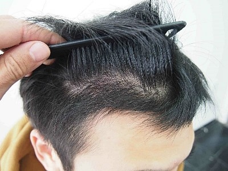 수술 후 4개월 경과 2.jpg