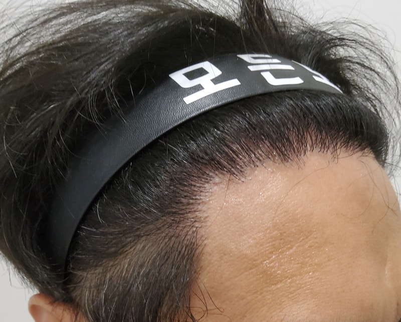 4. 수술후_6개월_3.jpg