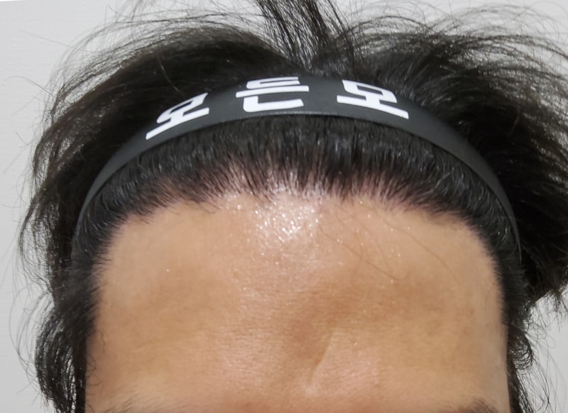 4. 수술후_6개월_1.jpg
