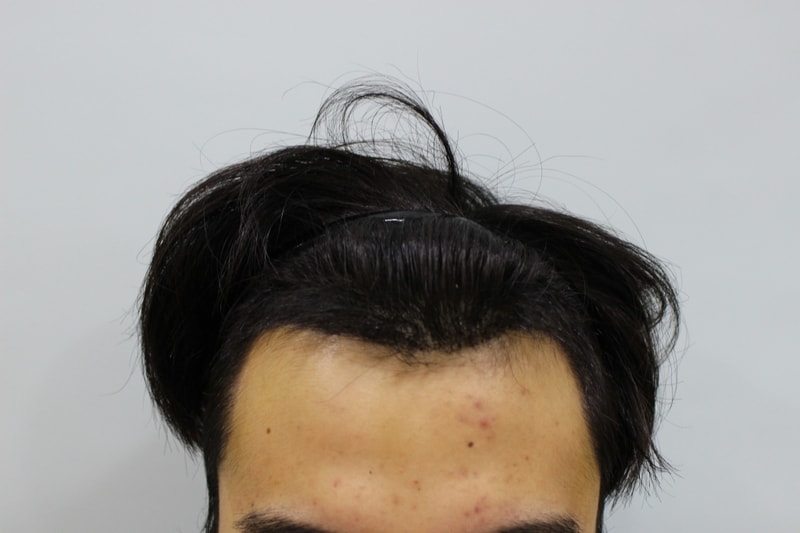 수술후 10일 (4).jpg