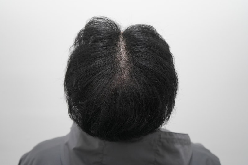 모아트 1400모낭 모발이식 4개월차 후기