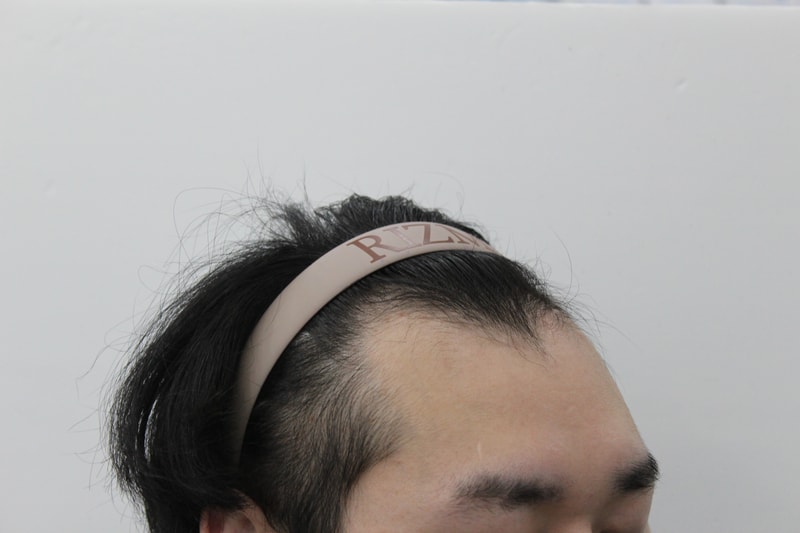 수술 전 옆면.jpg