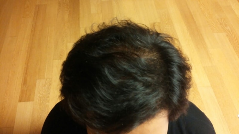 수술후 10일 (2).jpg
