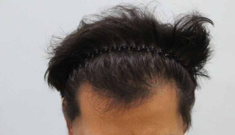 수술 전.JPG