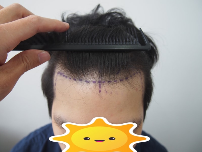 M자 모발이식 수술 현재 2주 정도 되었습니다