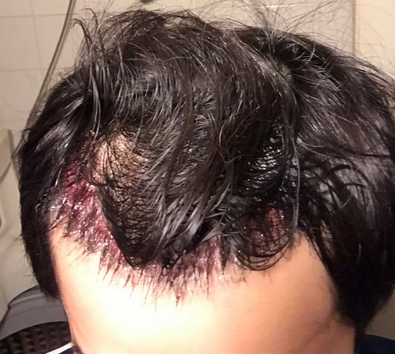 [NHI뉴헤어] 절개 1300모낭 수술 후기입니다