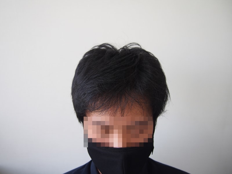 모재성 성형외과 8개월차 사진입니다~