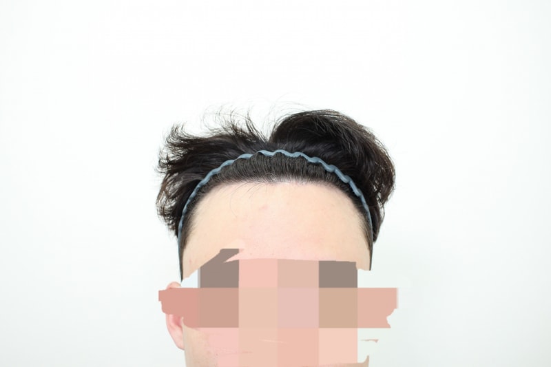 Second Week Hair Transplantation Review