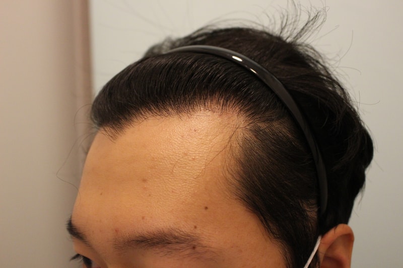 수술후 13개월 10.JPG