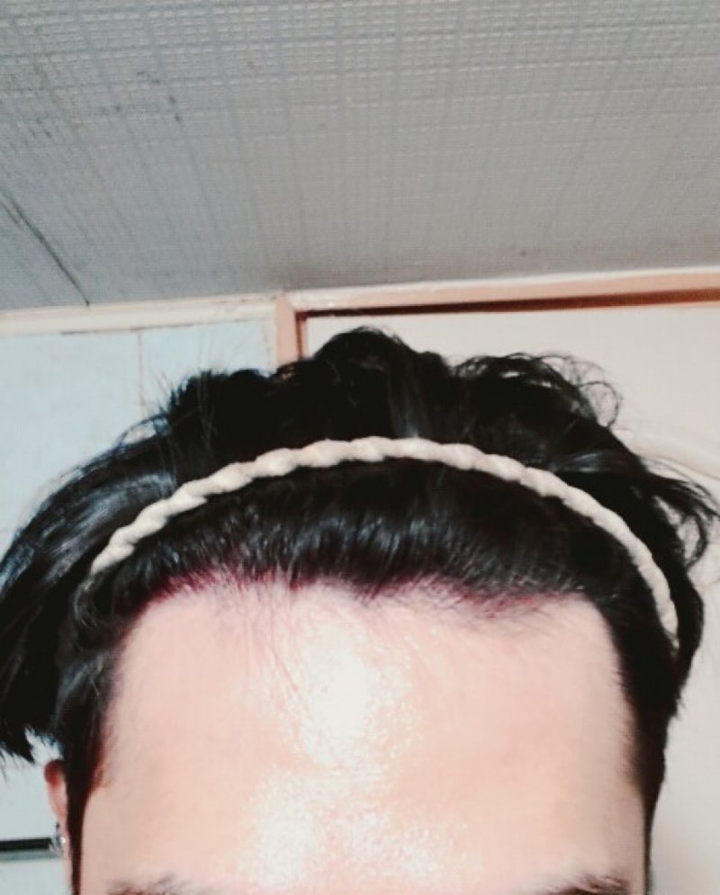 모재성 800모낭 1년 경과 후기