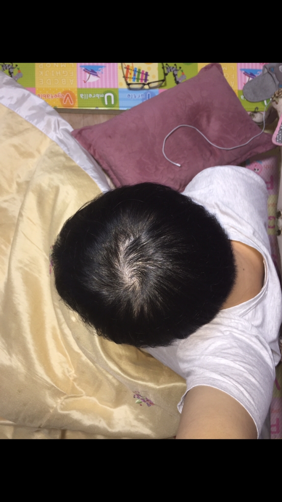 모발이식 8개월