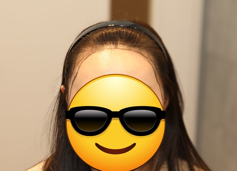 뉴헤어모발성형외과 모발이식(절개/1600모낭)수술 후 9개월차 솔직후기