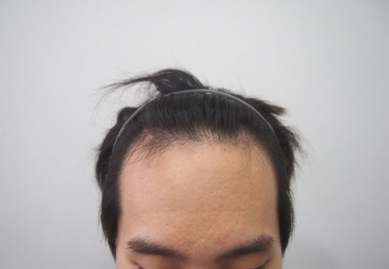 1465모낭 3672모 비절개 수술 오늘부로 1년 후기