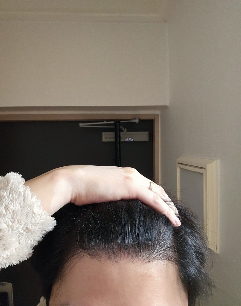 모재성 비절개1500모 8개월차 후기