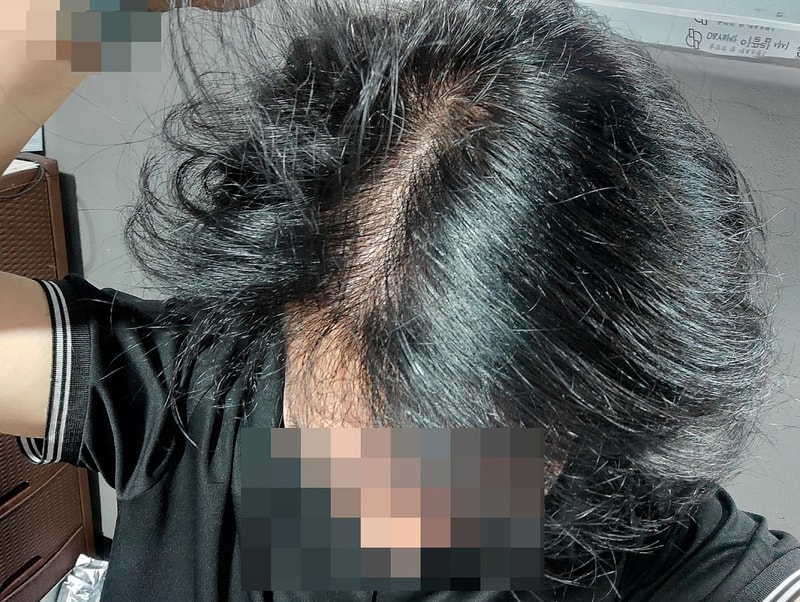 비절개 모발이식 3천모 7개월차 후기