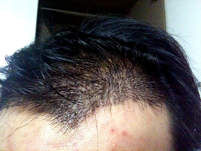 It's the second week of a new hair transplant.