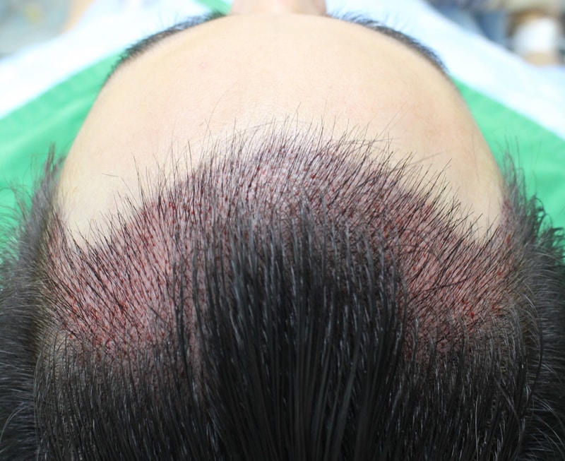 수술 후.jpg