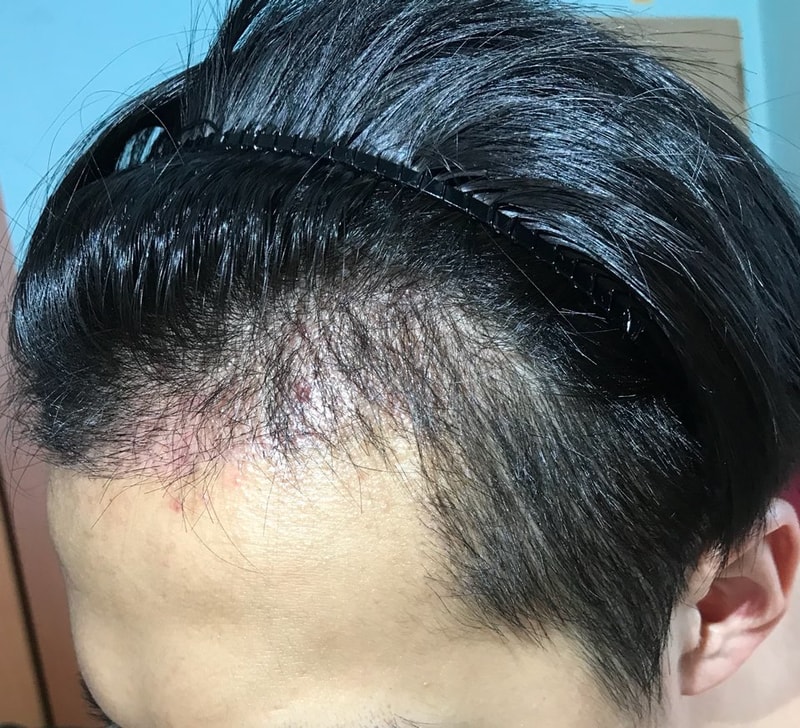 1개월차 왼쪽.jpg