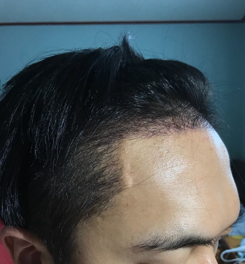 1개월차 오른.jpg