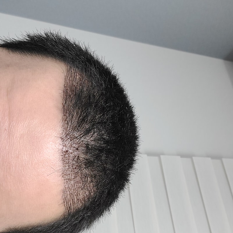Hannaive incision 3400 mo late + day 11